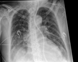 Gridless chest radiograph processed with SkyFlow