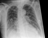 Gridless chest radiograph with standard processing